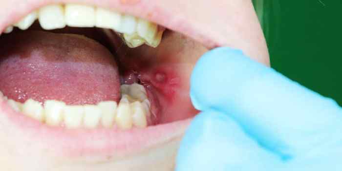 How to Treat Canker Sores - Yonge Eglinton Dental Canker sores how to treat prevent
