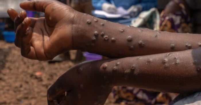 Dr. Pardis Sabeti Sierra leone mpox outbreak pardis sabeti christian happi essay