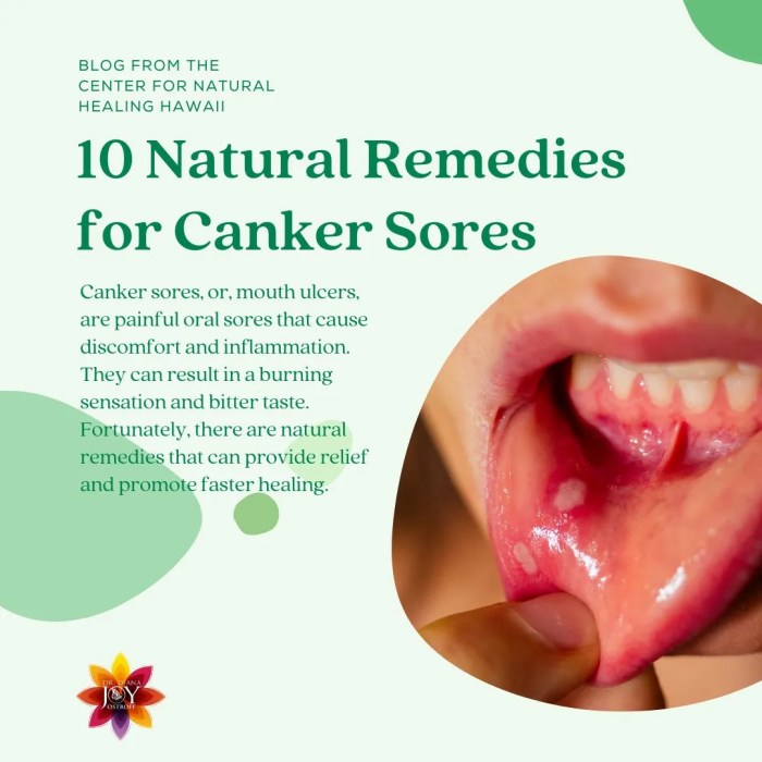 Canker Sores Make me a Cranky-saurus – PeRxSpectives Canker sores how to treat prevent