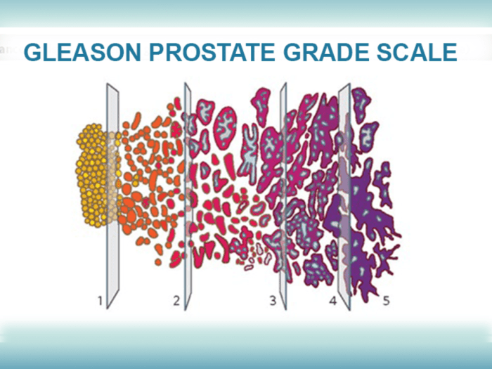 Diagnosing Prostate Cancer | Gleason Score | Top Urologists Biden prostate cancer diagnosis gleason score stage survival treatment explainer