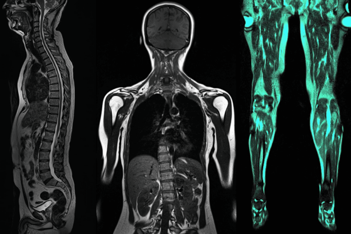 Full Body MRI Scan Chicago IL | Innovative Vitality Should you get full body mri scan