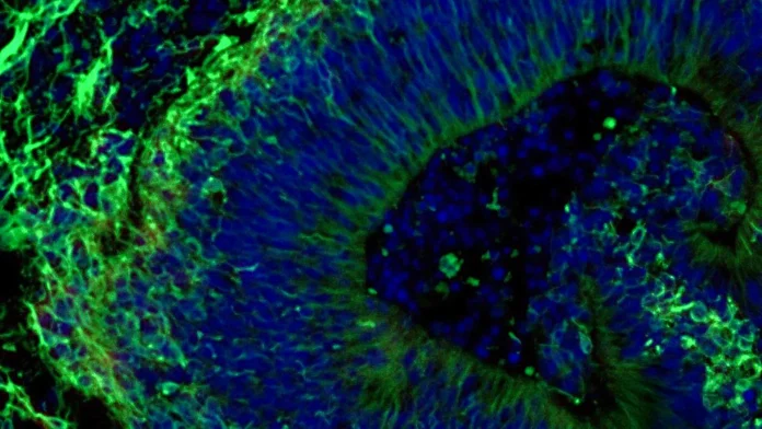 johns-hopkins-scientists-uncover-promising-new-pathway-for-personalized-alzheimers-treatment-using-mini-brain-models