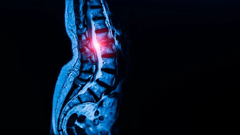 Unlocking the Blueprint of Movement: Researchers Discover Universal Tendon and Ligament Stem Cells With Implications for Spinal Stenosis