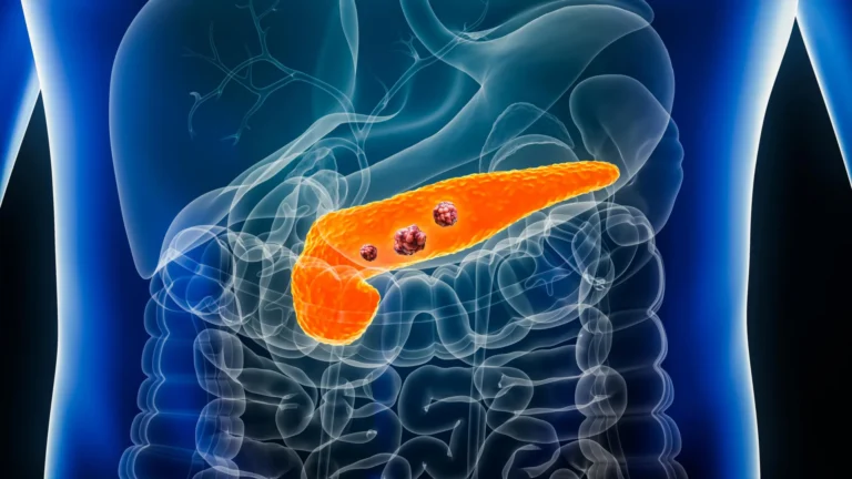 Artificial Intelligence Outperforms Radiologists by Detecting Hidden Pancreatic Cancer Signs Over a Year Before Diagnosis